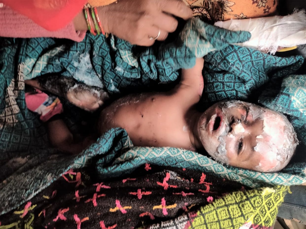 Hathras: Four-month-old innocent fell on burning fire, seriously scorched