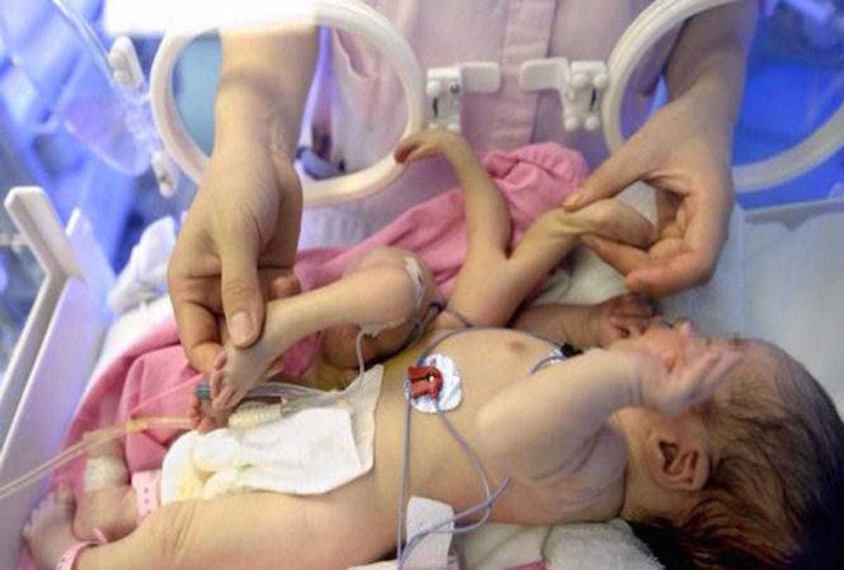 baby born with four hands four legs one head in katihar bihar news goes viral on social media