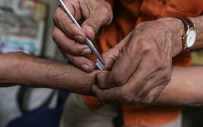 Health department will run Sparsh leprosy awareness campaign in Agra