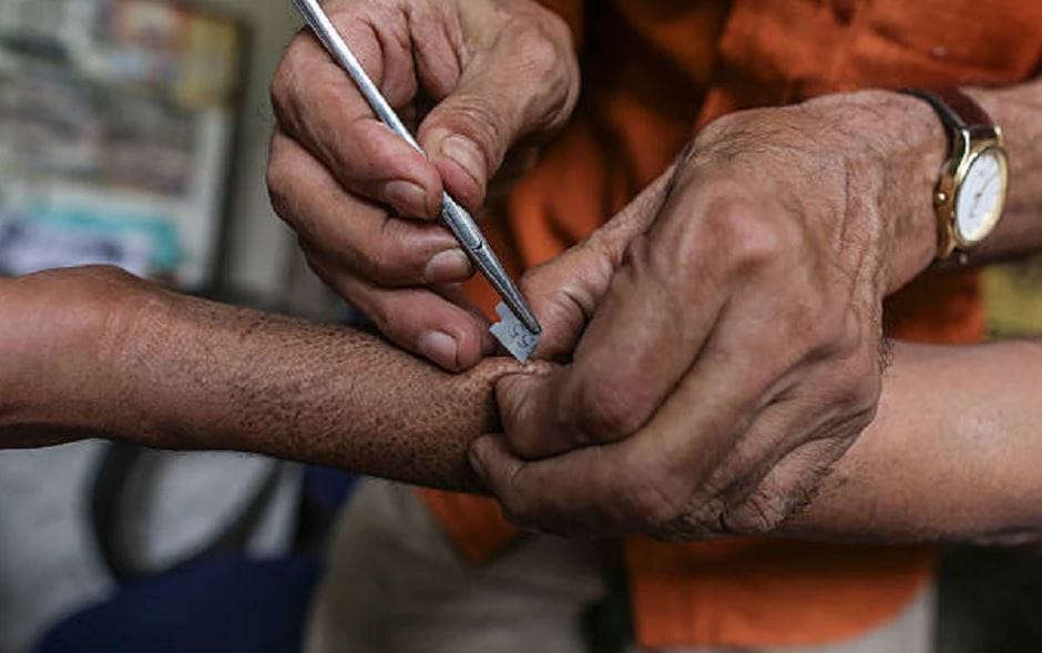World Leprosy Day, leprosy causes symptoms and treatment