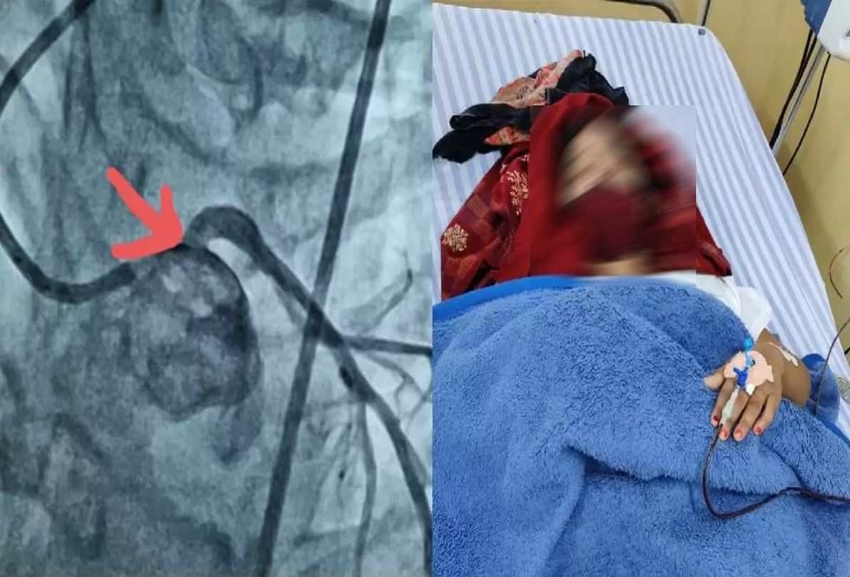 BHU Hospital Doctors straightened heart vein without surgery angioplasty of 35 years old female patient done