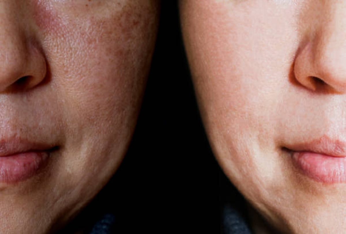 Home Remedies For Open Pores And tighten loose skin