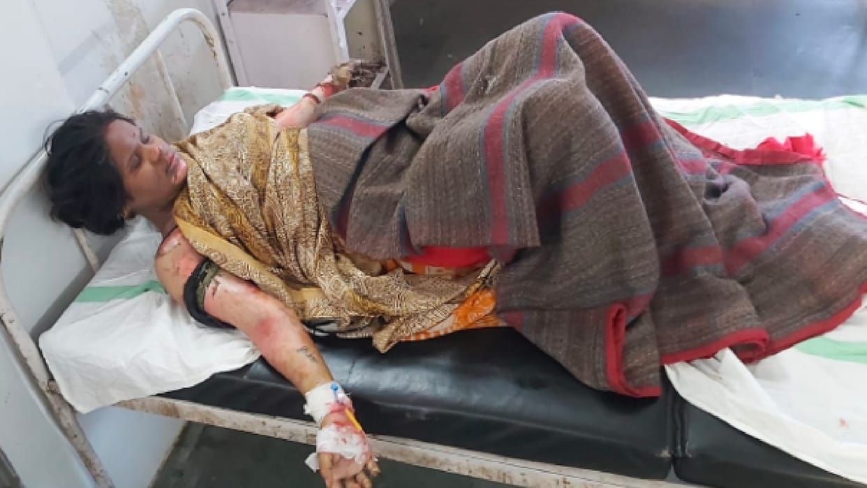 Chhatarpur Crime News: Married woman scorched, husband accused of setting fire by pouring kerosene