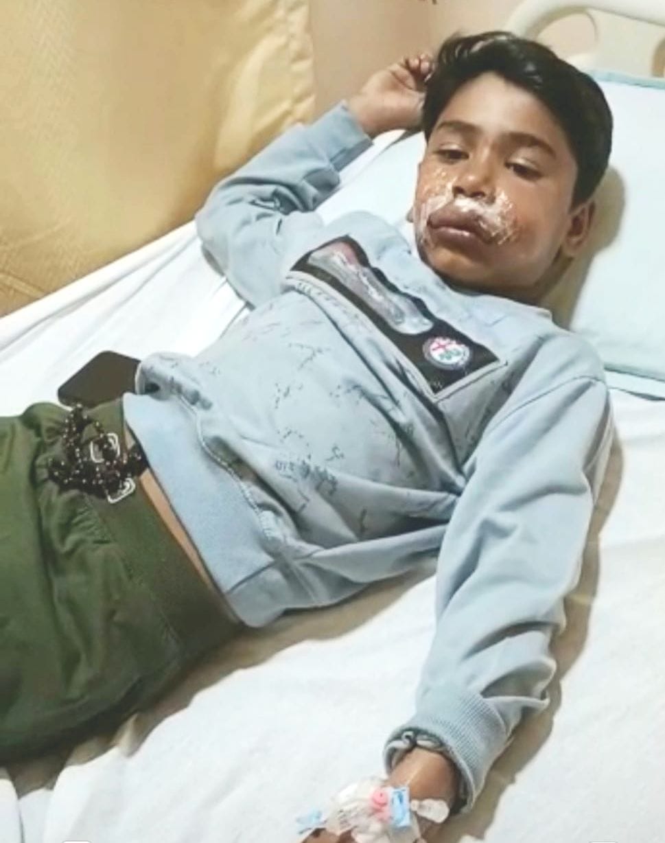 Pitbull attacked the face of a ten-year-old boy