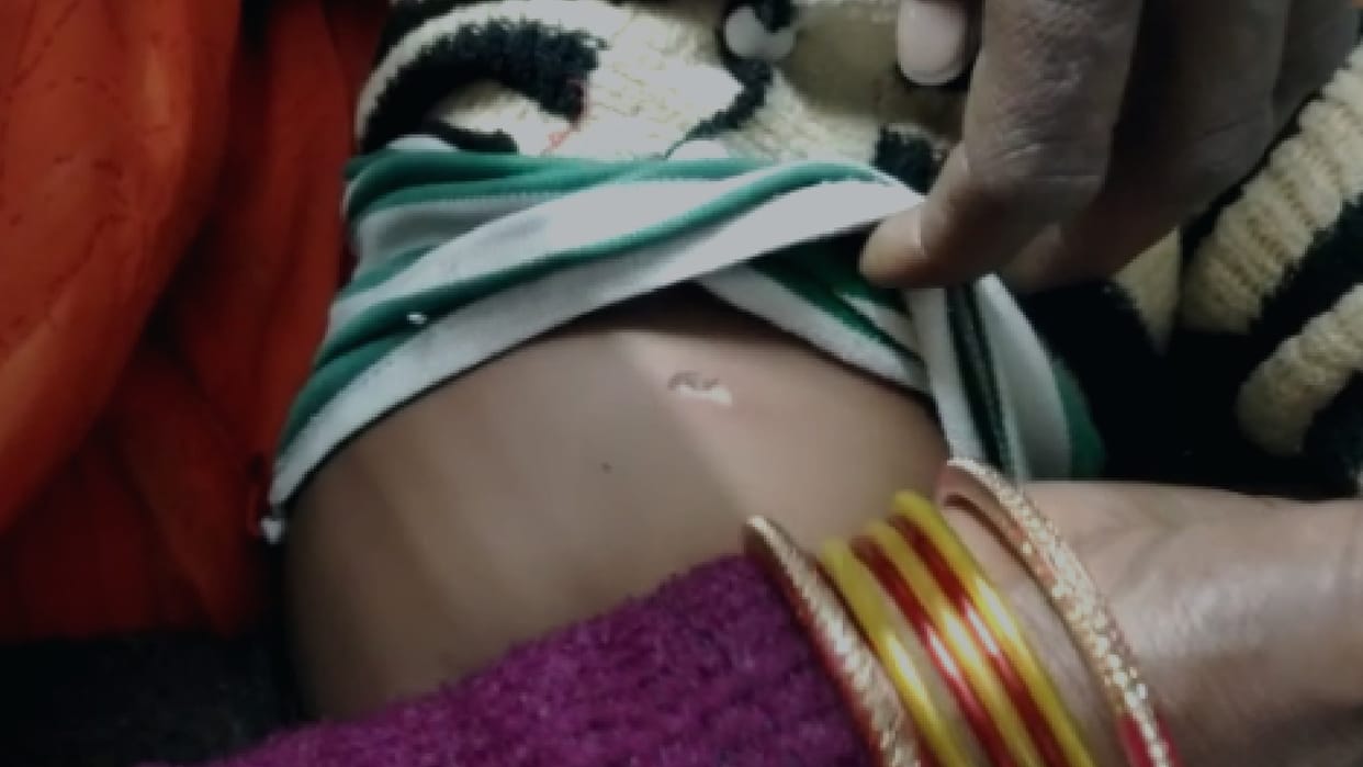 Superstition in Chhatarpur: Due to stomach ache, the girl was fired with a hot bangle, admitted to the district hospital due to deteriorating condition