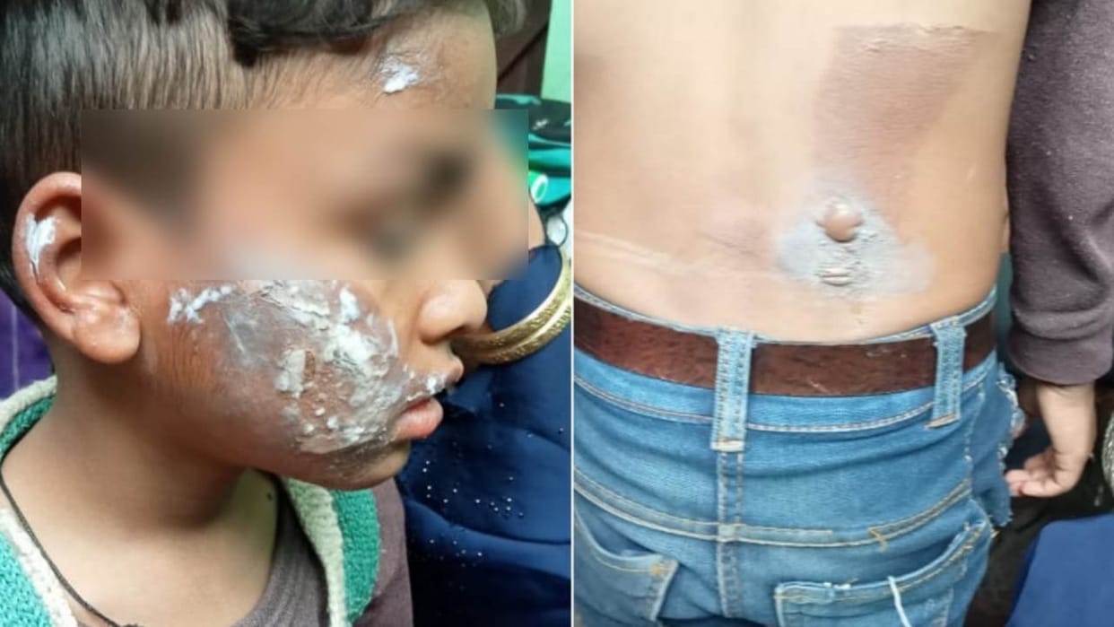 Stepmother burns seven year old son with press In Aligarh
