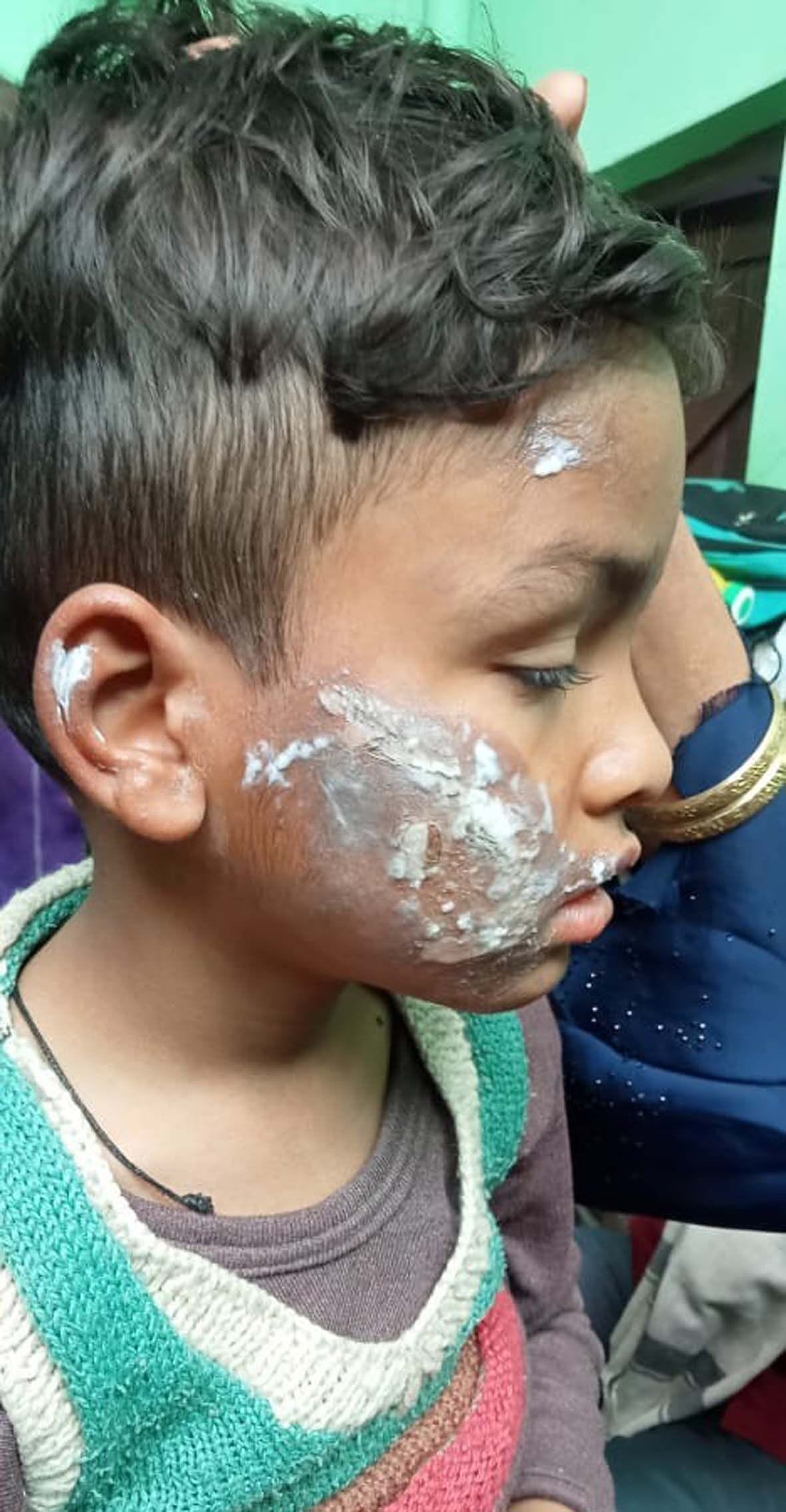 The stepmother burnt the child with a hot press for asking food