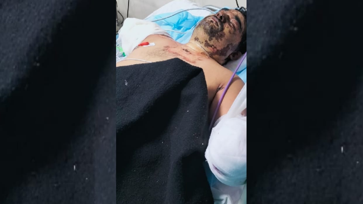 Lucknow: Both the hands of the contract electrician injured by the current are severed, treatment is going on in the trauma center