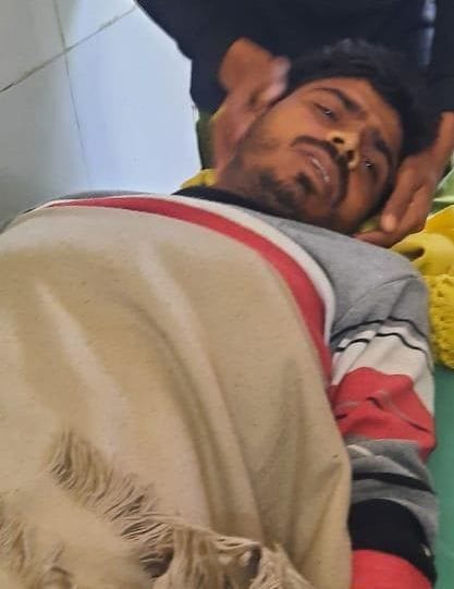 Hathras: Contract worker's feet scorched due to current in the line