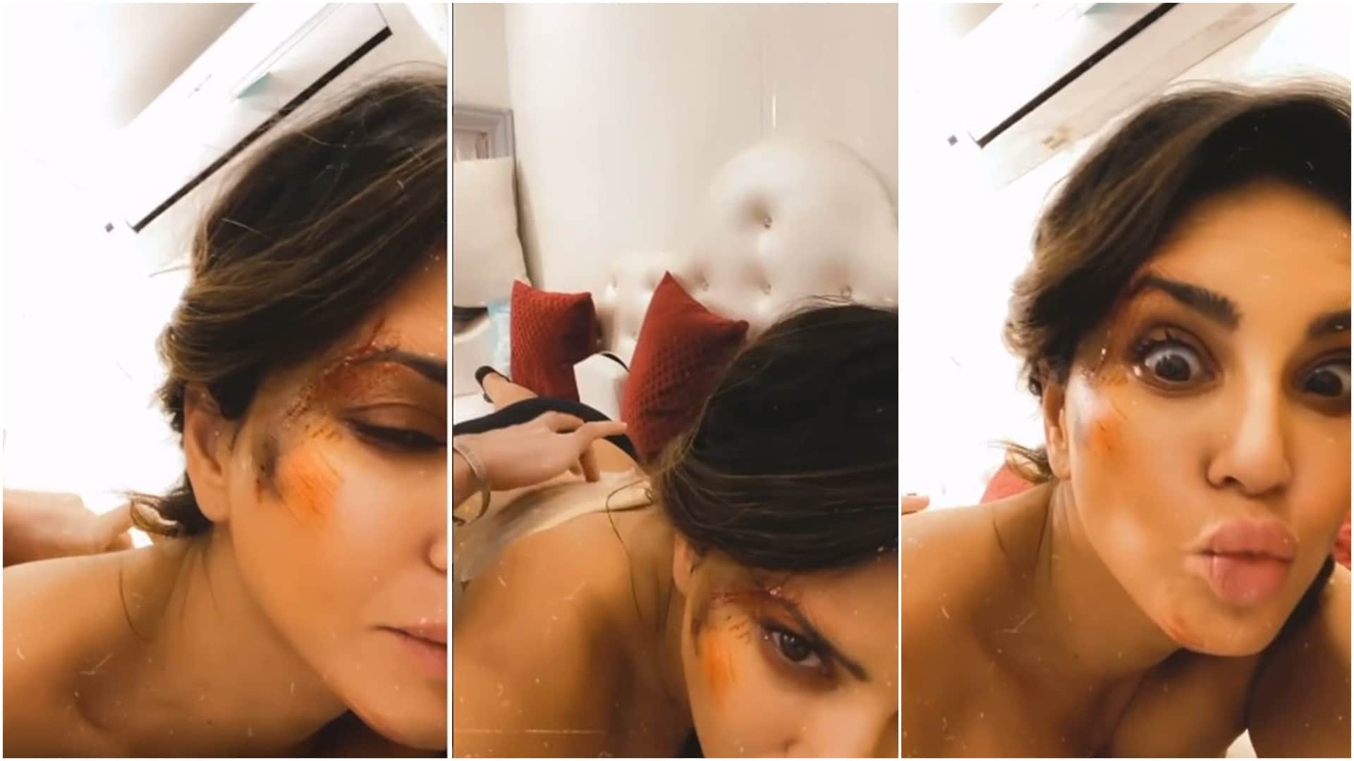Sunny Leone Injured: Sunny Leone injured during shooting, show facial wounds by sharing video on instagram
