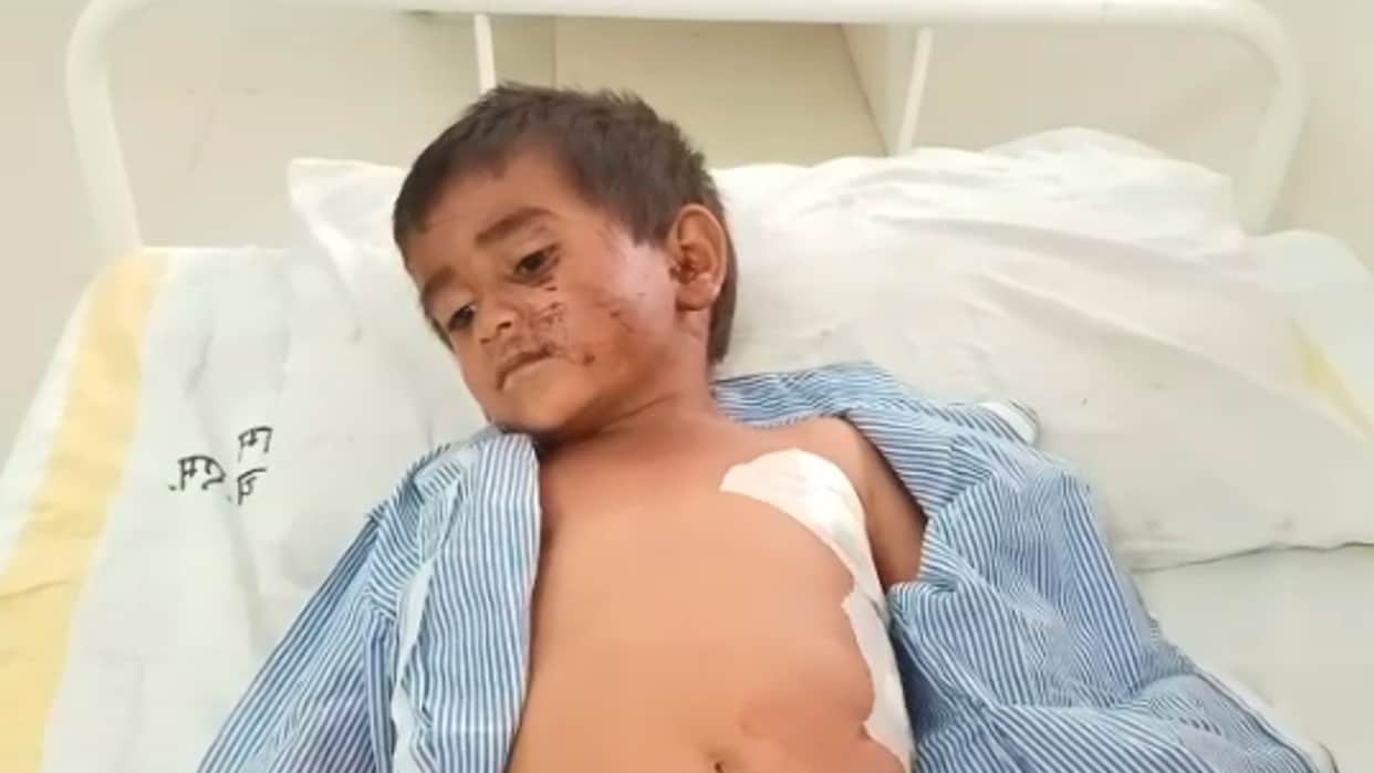 Dogs attack again in Dhar: Dogs pounced on a four-year-old child in village Padlya to eat, teeth buried in his mouth and chest