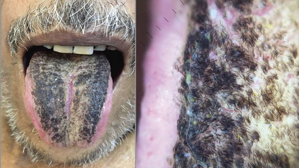 Black Hairy Tongue Syndrome Black Hair Started Growing on the Tongue of This Person Know the Reason
