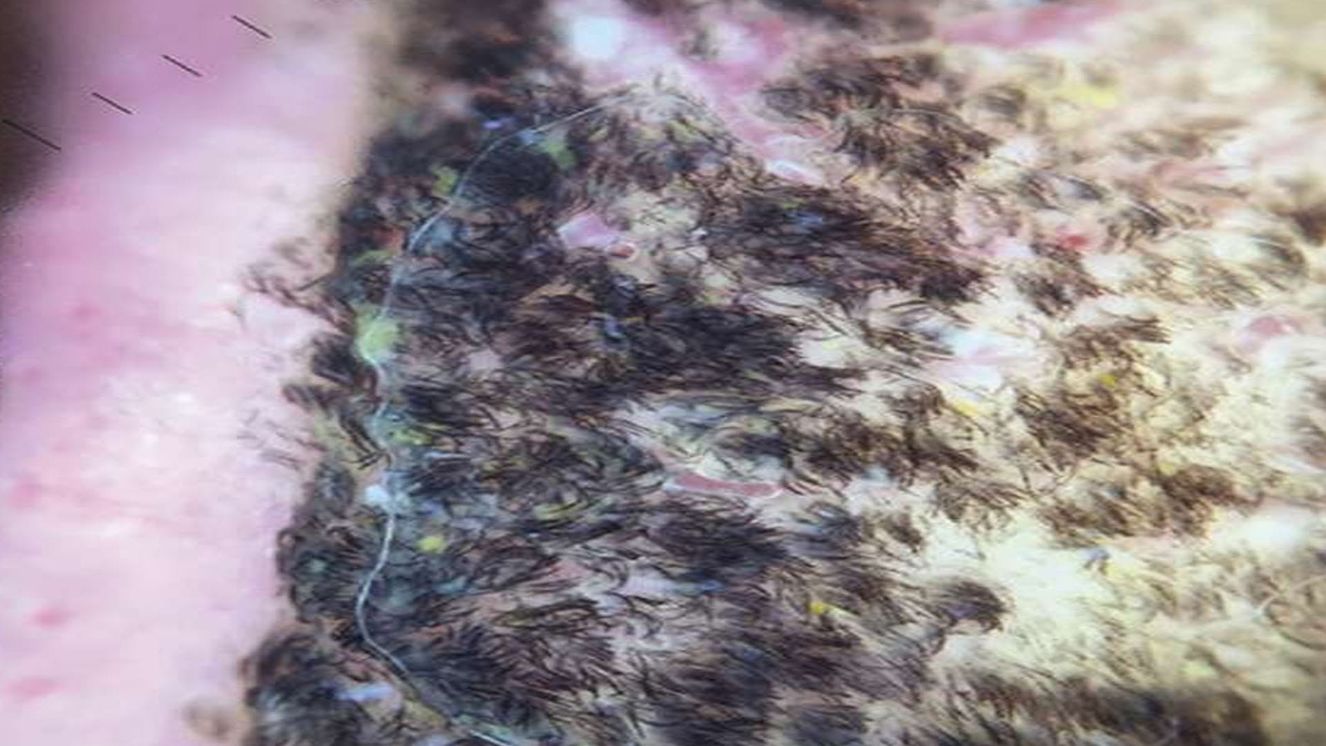 Black Hairy Tongue Syndrome Black Hair Started Growing on the Tongue of This Person Know the Reason