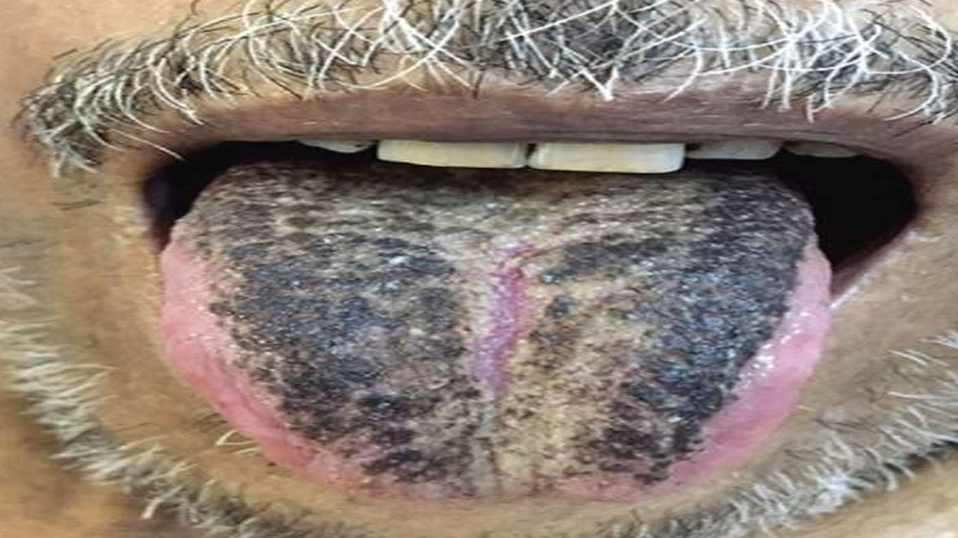 Black Hairy Tongue Syndrome Black Hair Started Growing on the Tongue of This Person Know the Reason