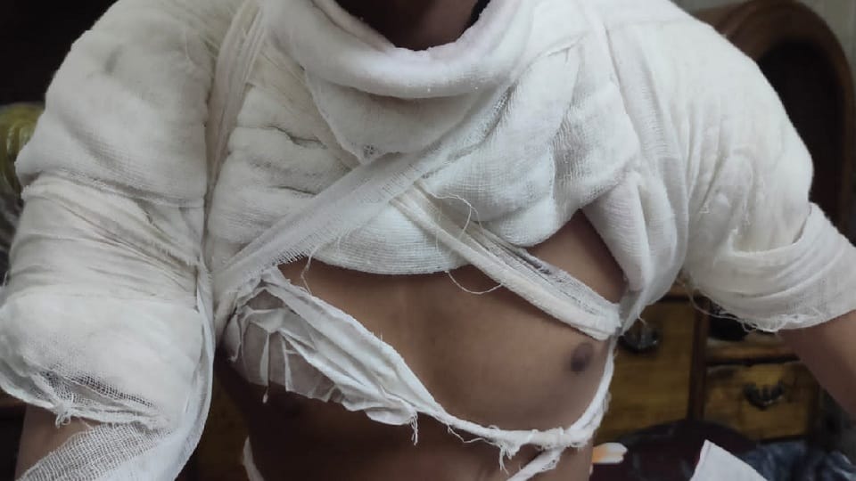 mechanic pour acid on a teenager in uttam nagar area delhi