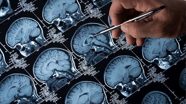 ischemic stroke death rate worldwide, what causes stroke and how to prevent it