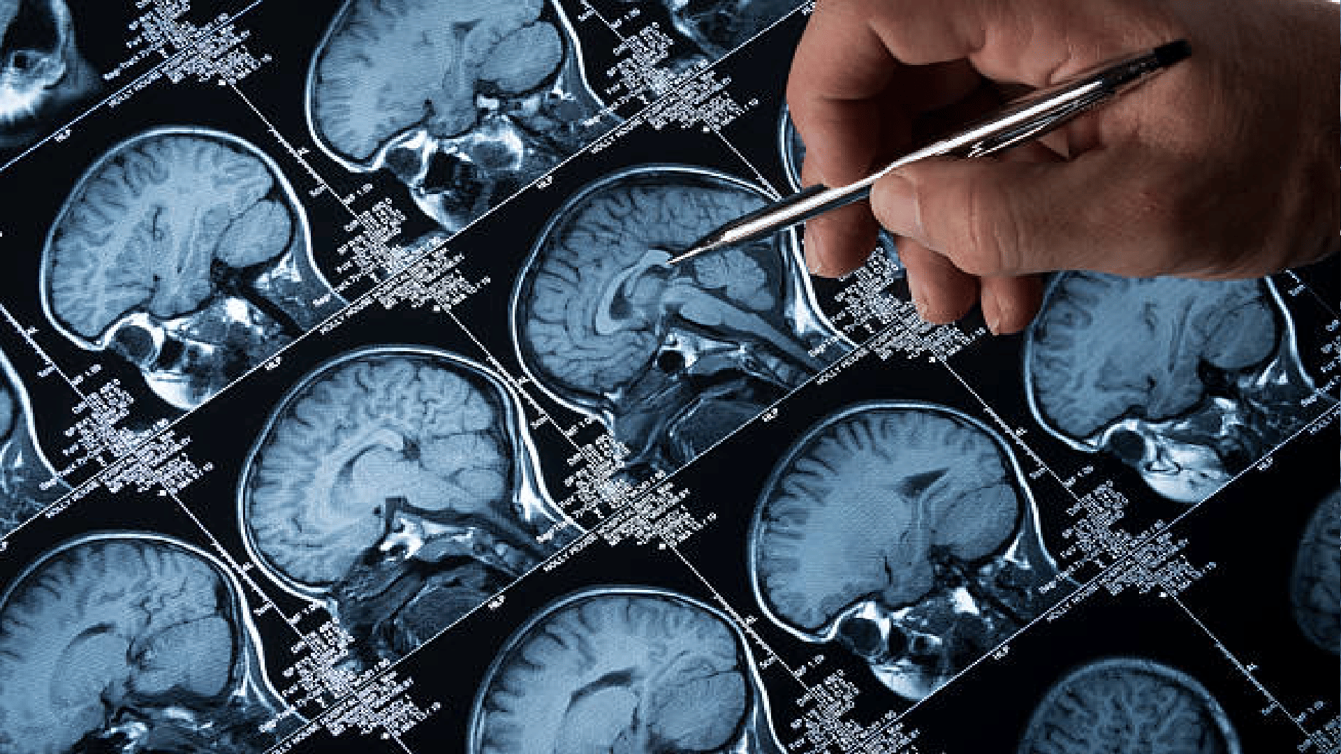 World Brain Tumor Day 2023, symptoms and causes of brain tumor and its prevention in hindi