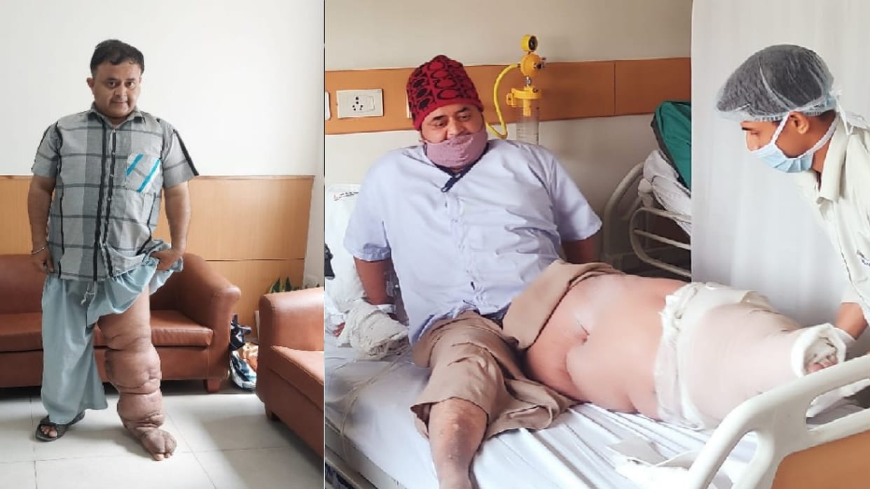 After ten years young man suffering from elephantiasis known as elephant foot stood on his feet