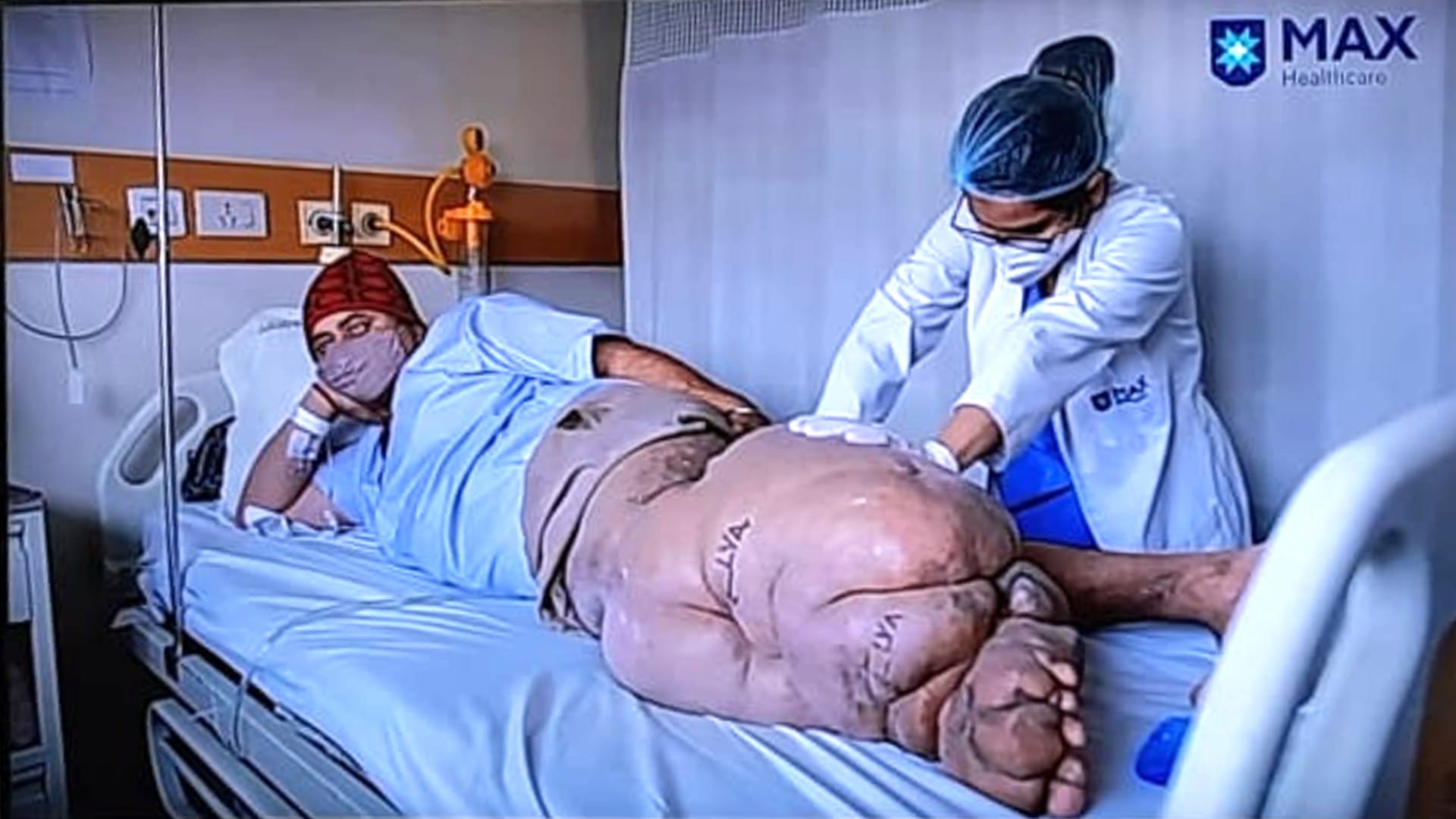 Elephantiasis Treatment, cause in hindi Super-microsurgery for Lymphedema Patient bedridden from 10 years
