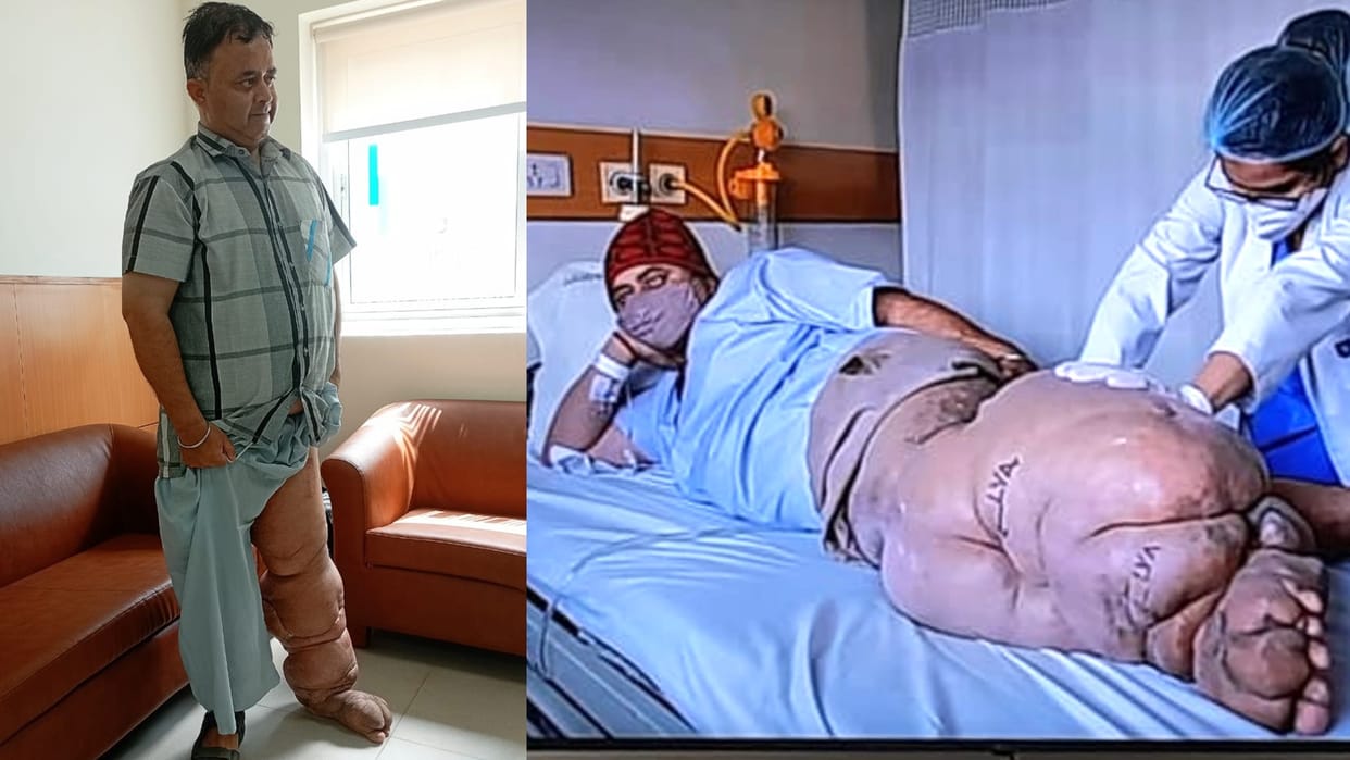 Elephantiasis Treatment, cause in hindi Super-microsurgery for Lymphedema Patient bedridden from 10 years