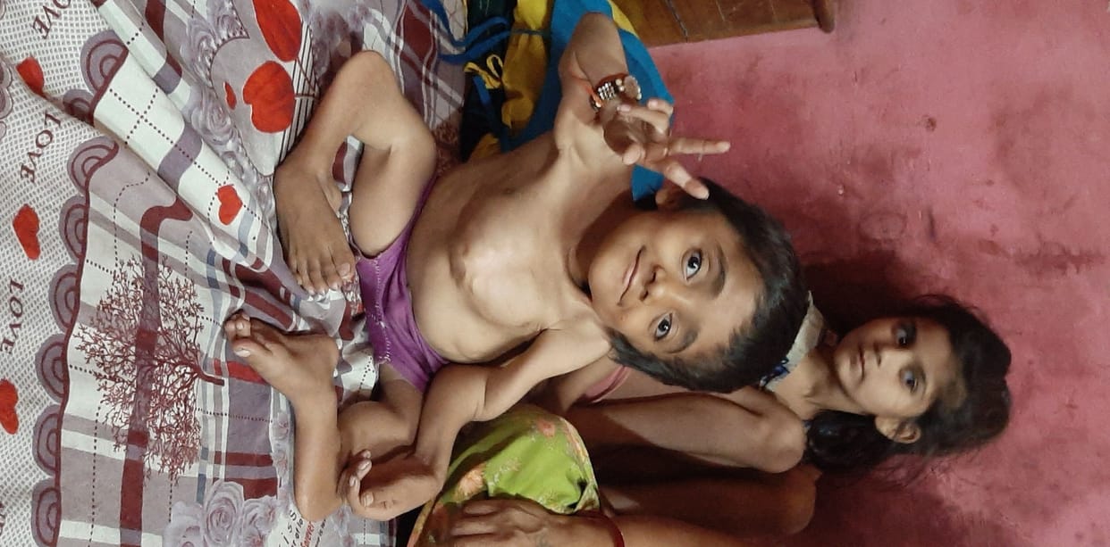 Hope for help to Rohit who is suffering from glass bone disease