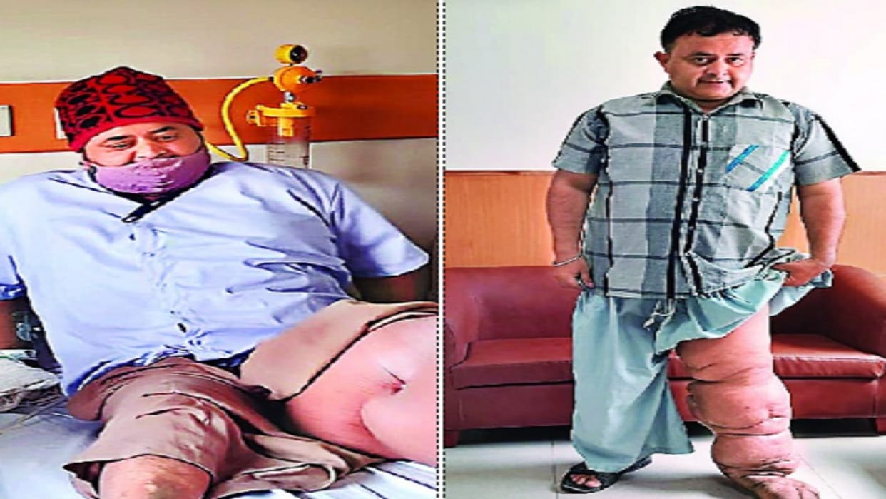 After 10 years the patient could stand on his feet, doctors did LVA micro surgery