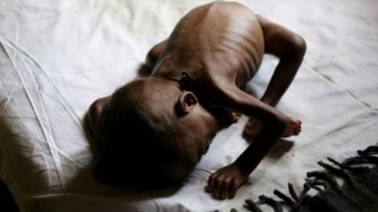 Burhanpur: A child without a mother became a victim of malnutrition, weighs only 4 kg in 10 months, Human Rights Commission sought answer