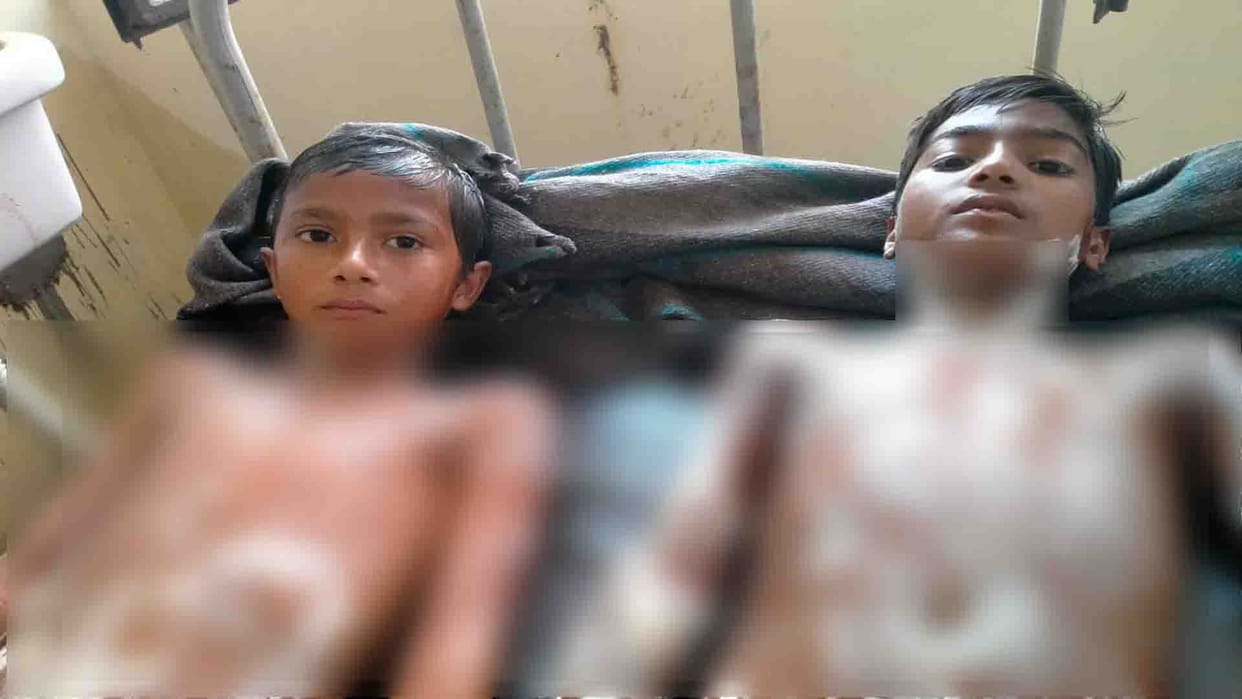Some students got scorched in the accident during mid day meal