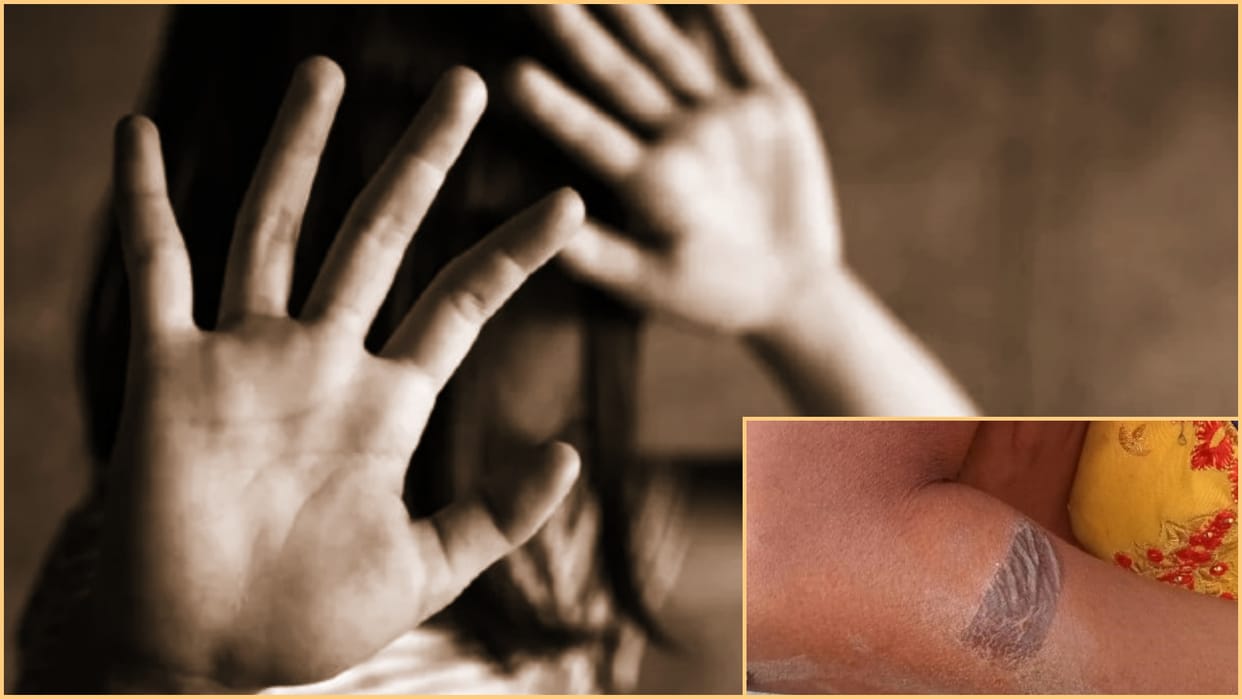 13-year-old girl hand and face burnt by her sister-in-law with hot knife in Udaipur