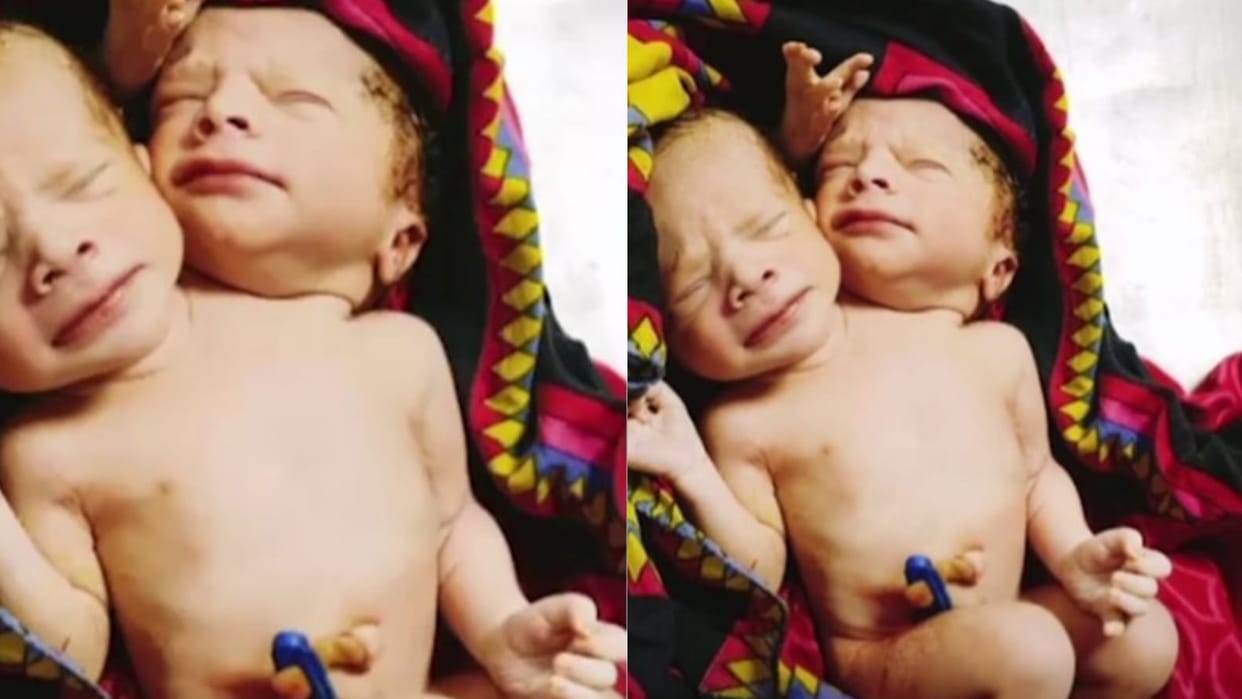 Unique child born in Ratlam: Two heads and three hands are connected to the same torso, doctors told the miracle of science