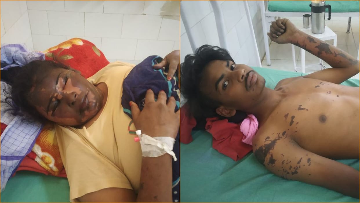Youth threw acid on mother and son in Sirsa of Haryana