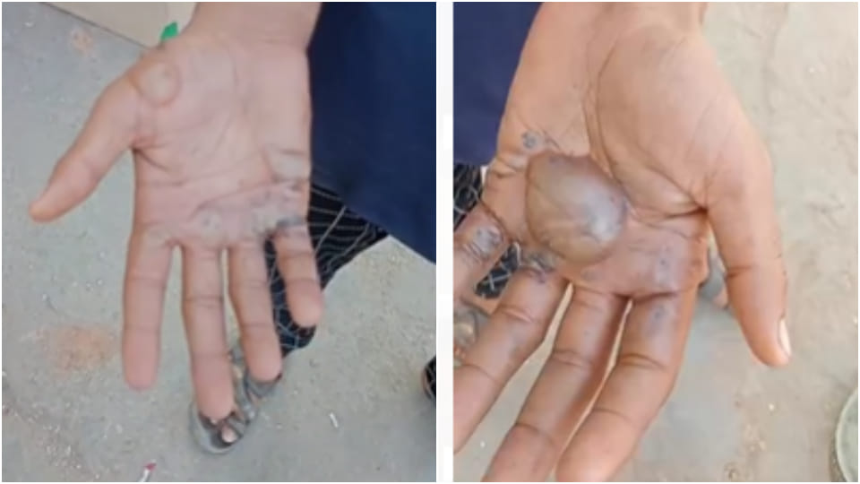 On suspicion of mobile theft hotel owner put a hot iron chain on child hand in nagaur
