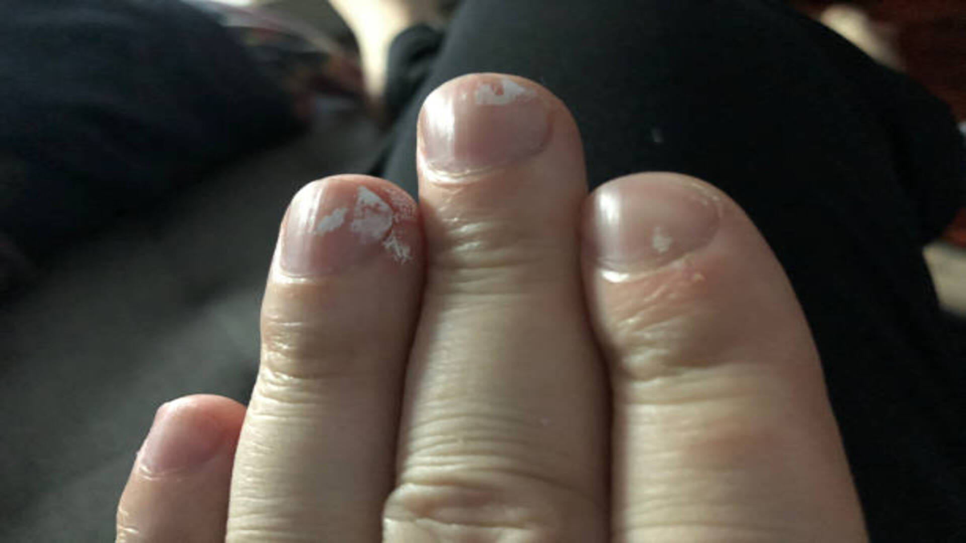 blue nails are symptoms of heart problem, nail colour changes and disease