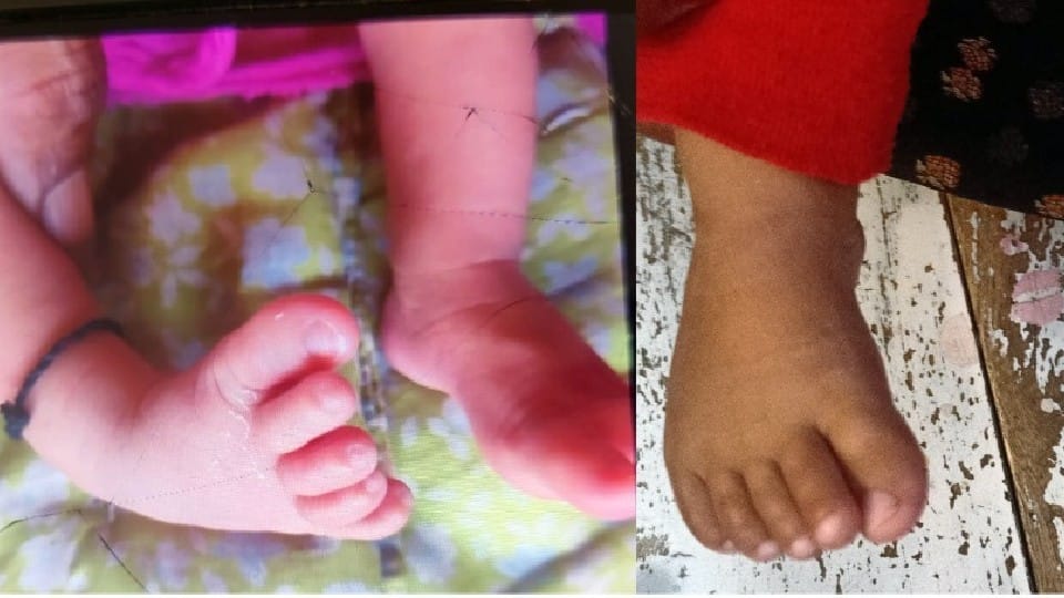 Babys crooked leg got cured after 11 months of treatment in jodhpur 