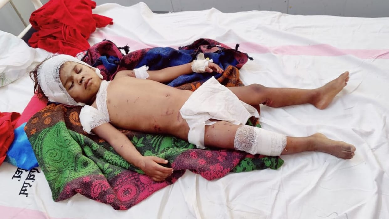Terror of street dogs in Chhatarpur: Two and a half year old girl playing outside the house was dragged away, bitten at places, treatment continues