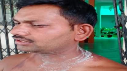 युवक पर फेंका तेजाब।