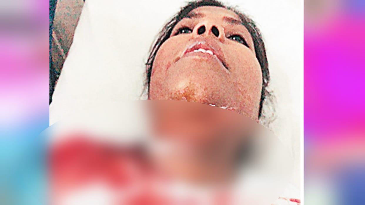 Chinese Manjha becoming the reason of death in Meerut, Scooty riding girl got hit, 40 stitches in neck