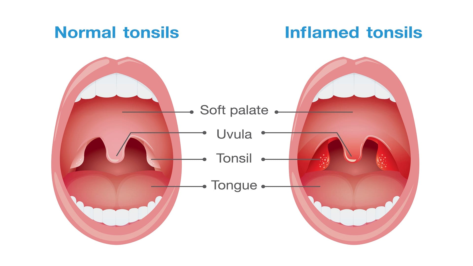 Tonsillitis Causes Symptoms and Treatment It is Very Painful and Unwell Conditions Know All About in Hindi
