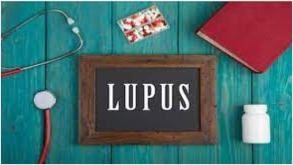 World Lupus Day 2022 Patient will be fine with timely treatment and balanced diet says Dr Sudhir Bhandari
