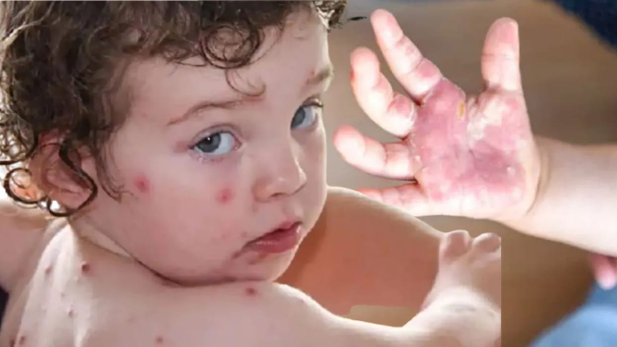 Hand foot and mouth disease started spreading in Punjab