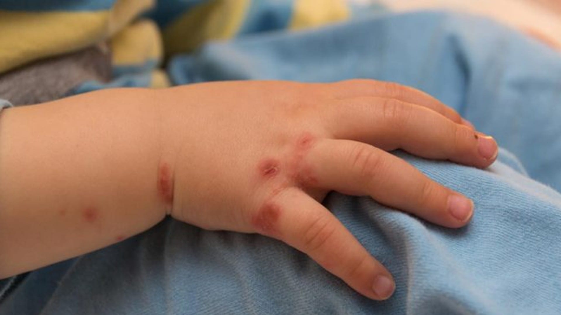 What is tomato fever Symptoms, prevention and treatment