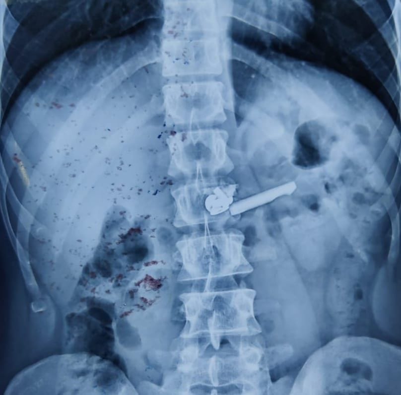 Remove nails, screws, leaves and pieces of glass from the stomach by endoscopy
