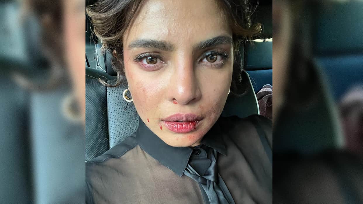 Priyanka Chopra shared  picture with injured face fan said what happened are you ok