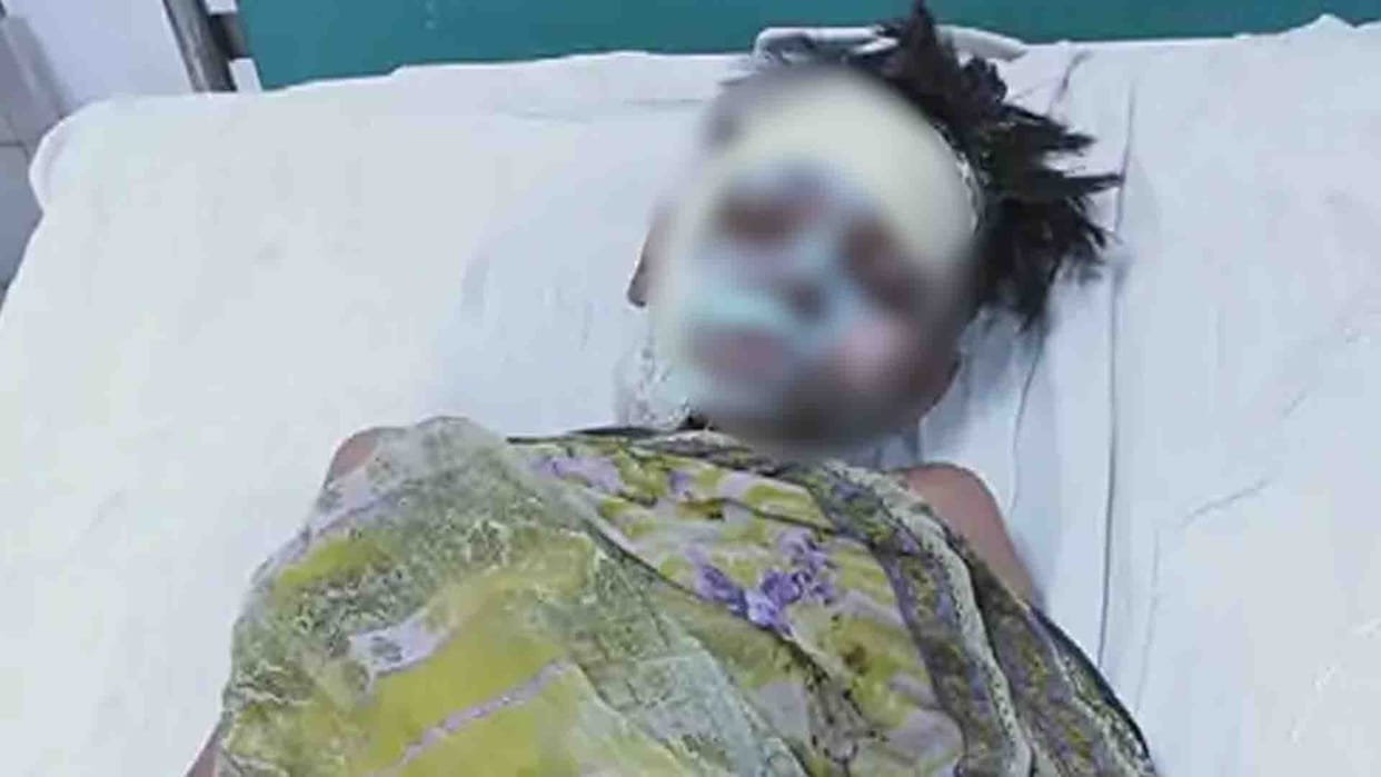 Kanpur: Minor friend burnt by putting sanitizer