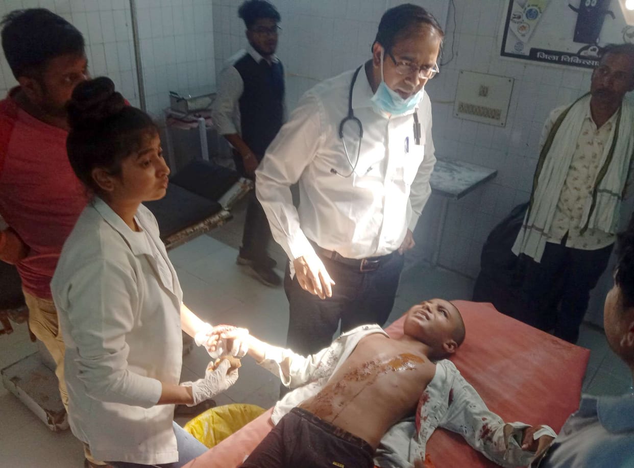 Kashir scorched due to exploding mobile battery