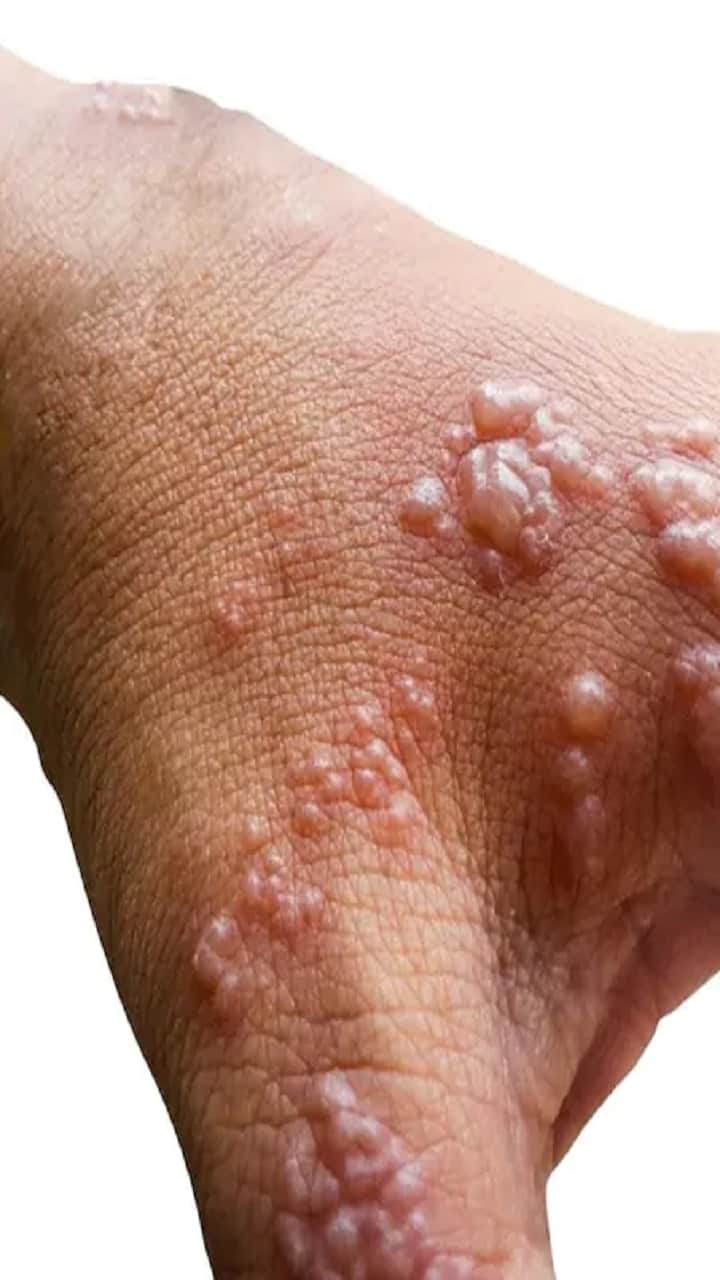 monkeypox outbreak in european countries, UK patients have different symptoms, study finds