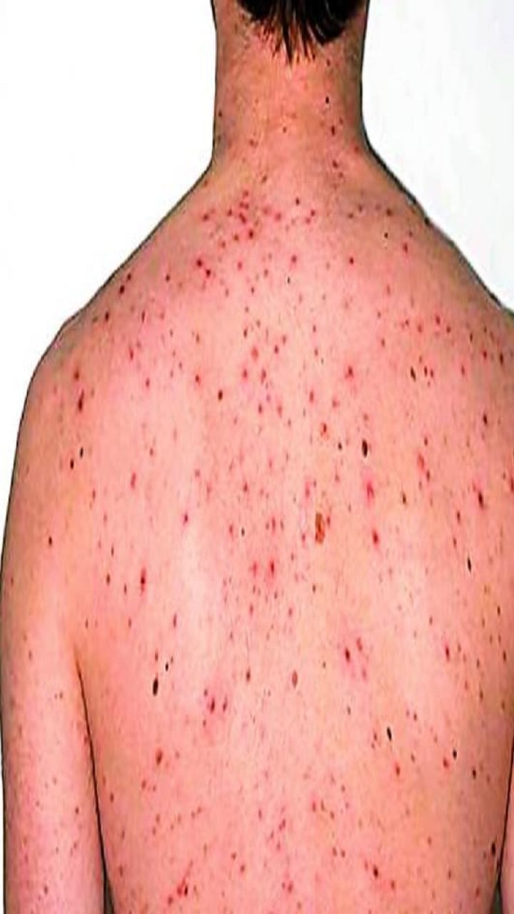 monkeypox in india updates, outbreak raising concerns globally