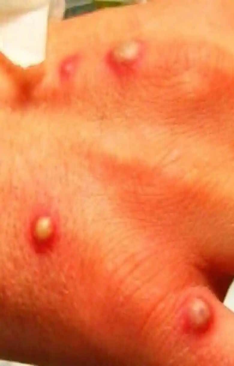 monkeypox outbreak in european countries, UK patients have different symptoms, study finds