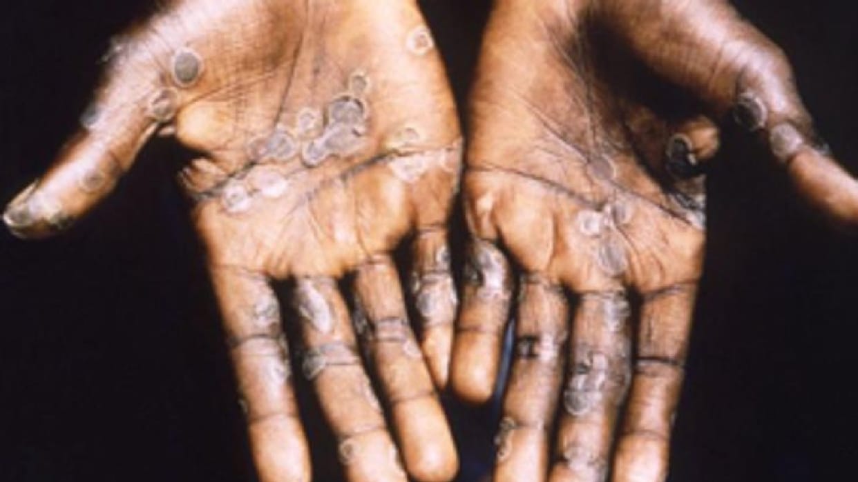 Bijnor: Health Department alerts about monkeypox disease, people coming from Africa will be reporting