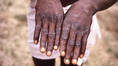Centre has formed the task force to monitor monkeypox cases in India